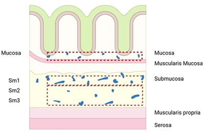 Predictors of early colorectal cancer metastasis to lymph nodes: providing rationale for therapy decisions